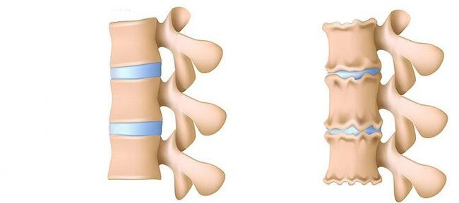 What is osteochondral disease