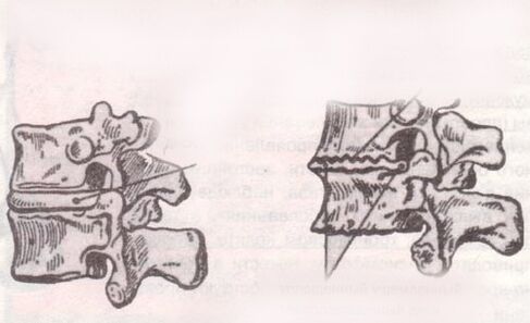 Intervertebral disc health, lumbar osteochondral disease