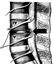 X-Pictures of waist and waist of osteochondrosis