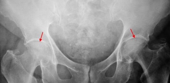 Double-sided co-bone mucosa in the joint space, sclerosis on the joint surface