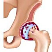 Hip arthritis