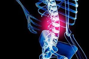 Lumbar osteochondrosis