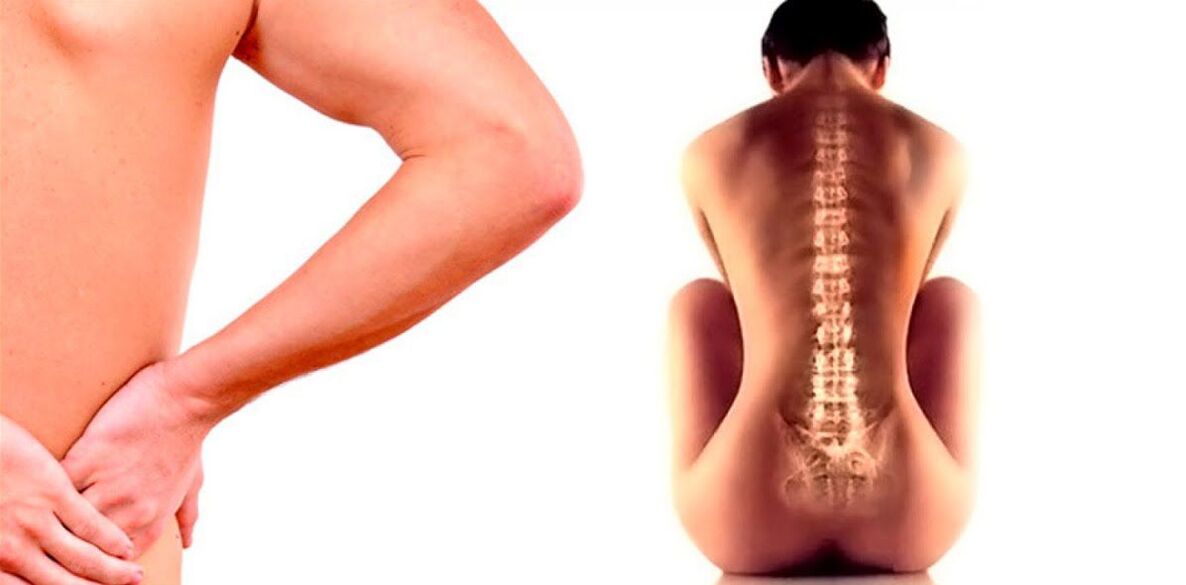 Low back pain caused by osteochondrosis