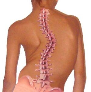 Curvature of the spine leading to osteochondrosis