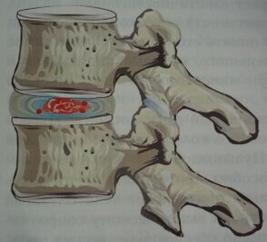 Osteochondrosis stage 1
