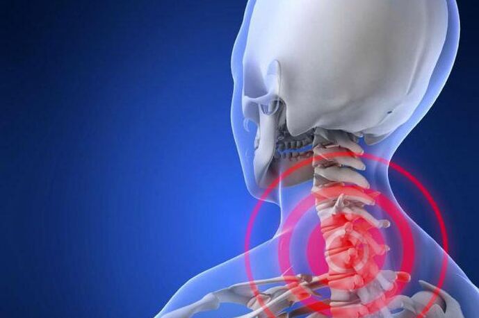 Severe neck pain is an early symptom of cervical osteochondrosis