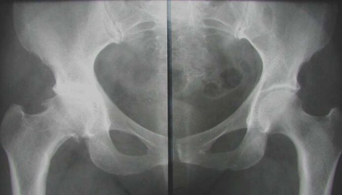 X-ray of the hip joint with arthropathy